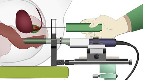 Fusionsbiopsie der Prostata Methode