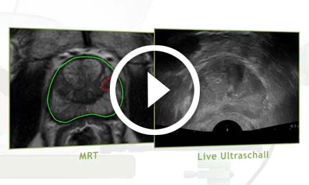 Video zur Fusionsbiopsie